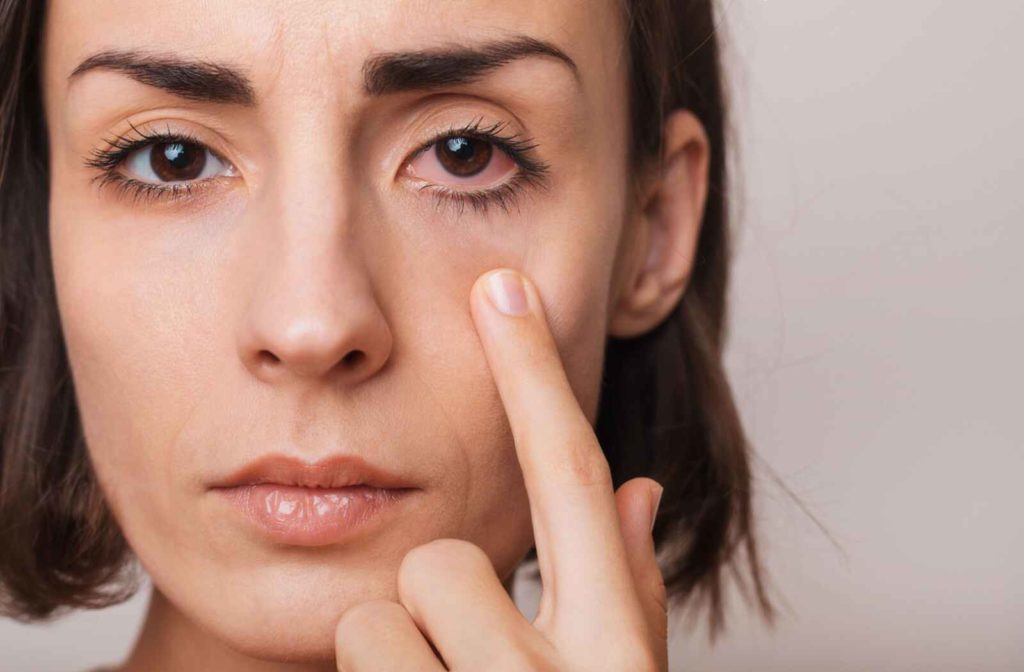 Close-up of a patient with dry eye pulling down their eyelid to indicate the redness due to dry eyes